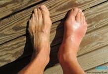 อาการบวม ( Edema ) อาการบวม ( Edema )