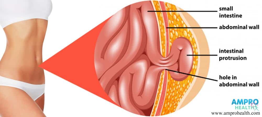 อาการปวดท้อง ( Abdominal Pain )