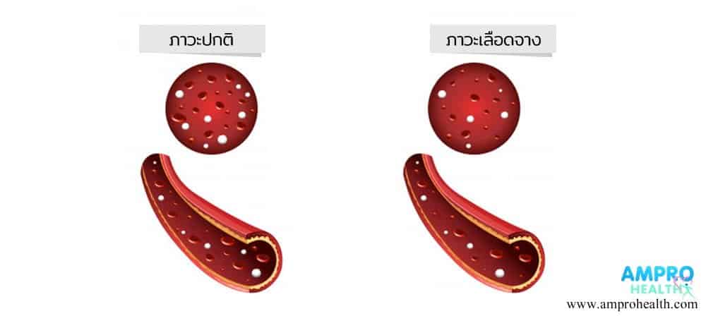 ภาวะเลือดจาง - โลหิตจาง ( Anemia )