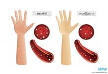 โลหิตจาง (Anemia): สาเหตุ อาการ และแนวทางการรักษา