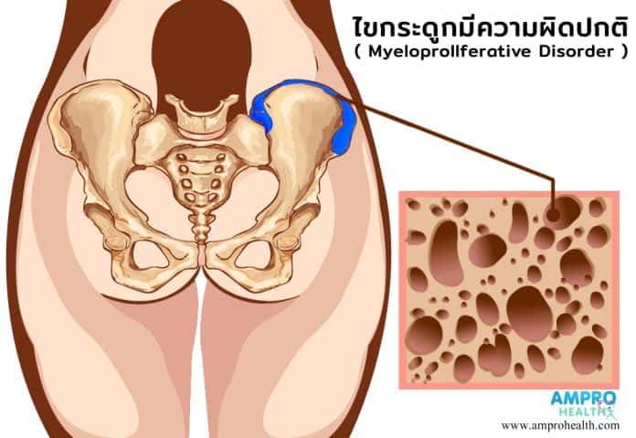 ไขกระดูกมีความผิดปกติ Myeloproliferative disease ( MPD )