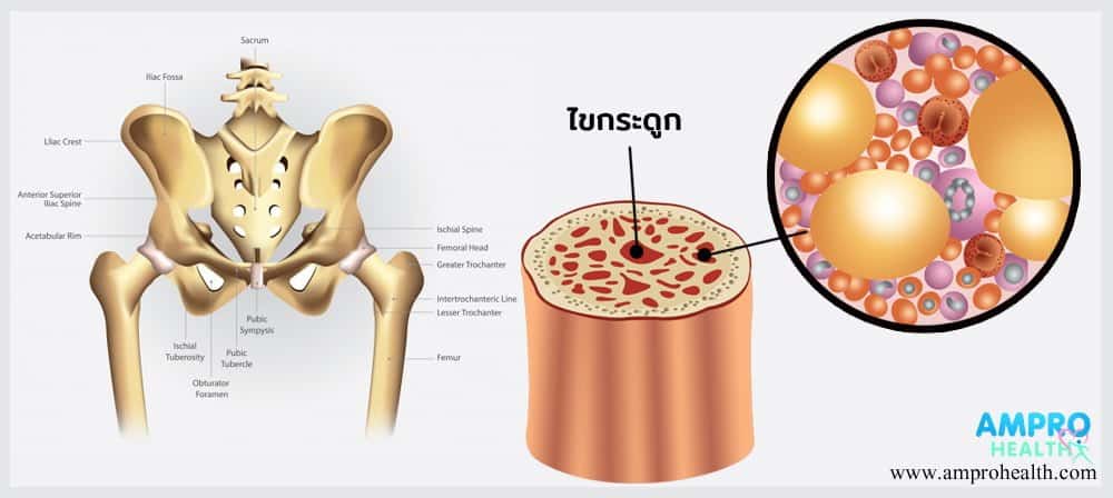 ไขกระดูกมีความผิดปกติ Myeloproliferative disease ( MPD )