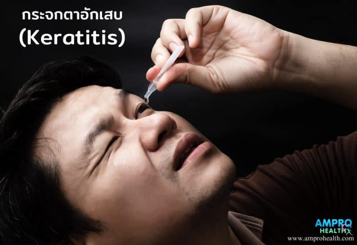 กระจกตาอักเสบ ( Keratitis )