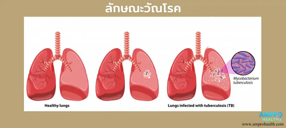 วัณโรค ( Tuberculosis )