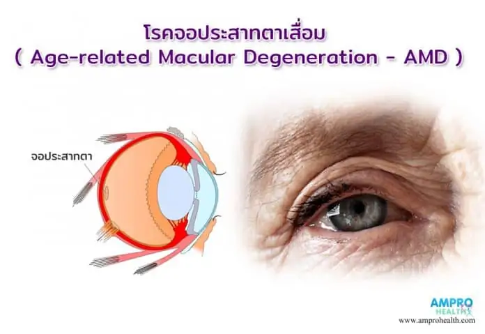 โรคจอประสาทตาเสื่อม ( Age-related Macular Degeneration - AMD )