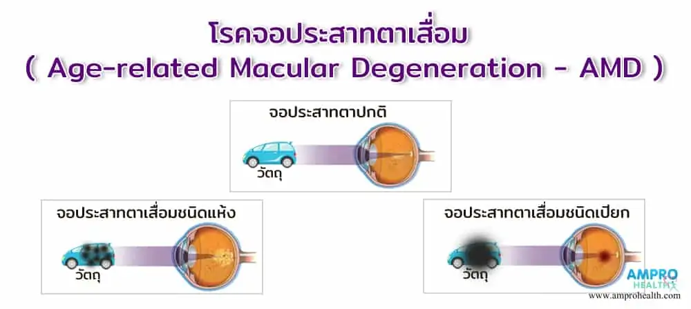 โรคจอประสาทตาเสื่อม ( Age-related Macular Degeneration - AMD )