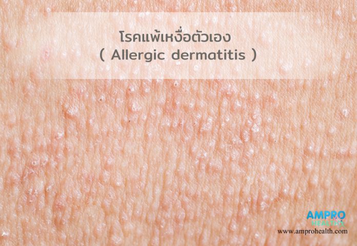 โรคแพ้เหงื่อตัวเอง ( Allergic dermatitis )