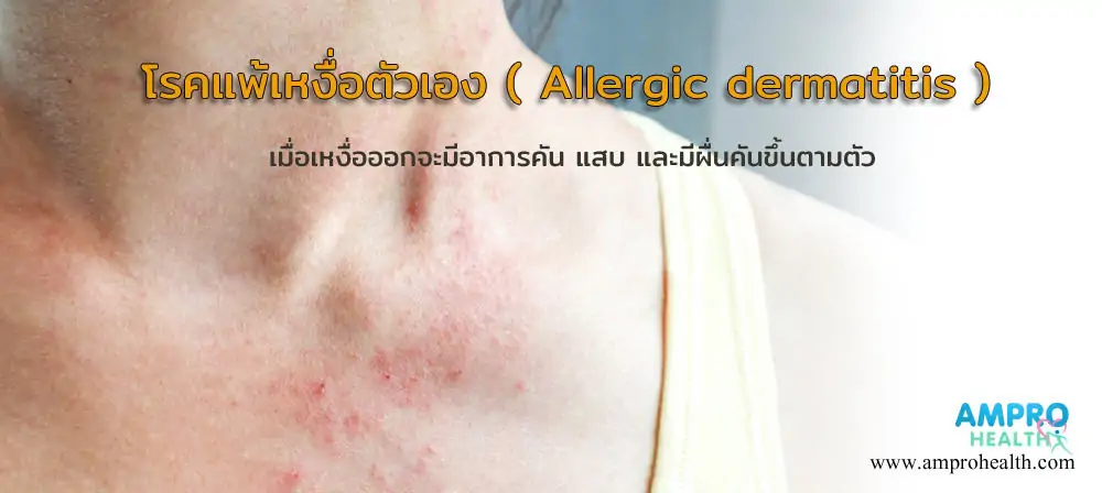 โรคแพ้เหงื่อตัวเอง ( Allergic dermatitis )