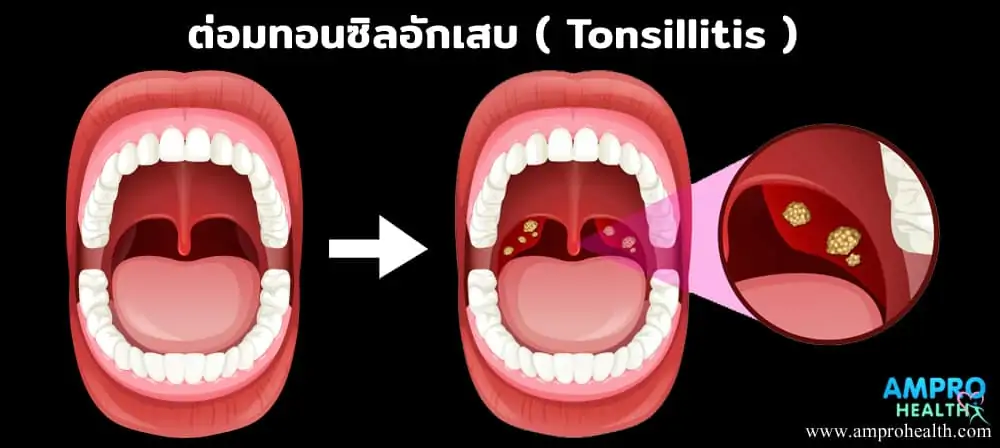 ต่อมทอนซิลอักเสบ ( Tonsillitis )
