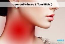 ต่อมทอนซิลอักเสบ ( Tonsillitis ) ต่อมทอนซิลอักเสบ ( Tonsillitis )