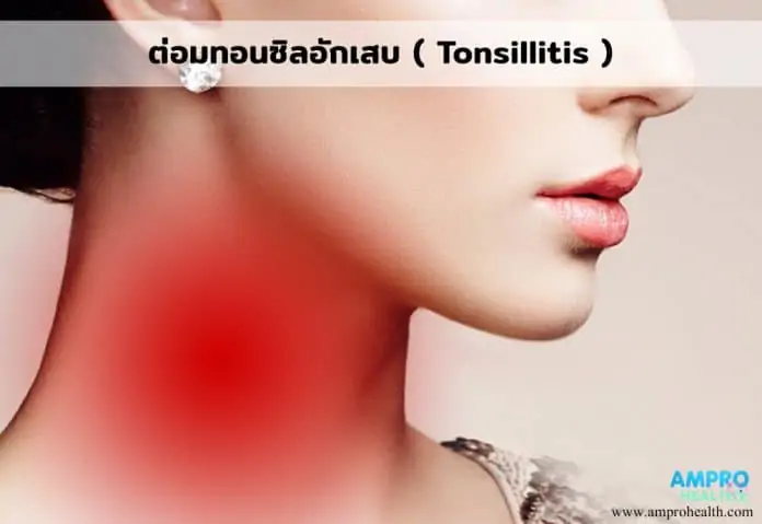 ต่อมทอนซิลอักเสบ ( Tonsillitis )