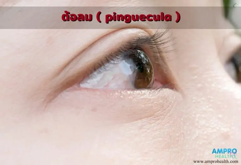 ต้อลม ( Pinguecula )