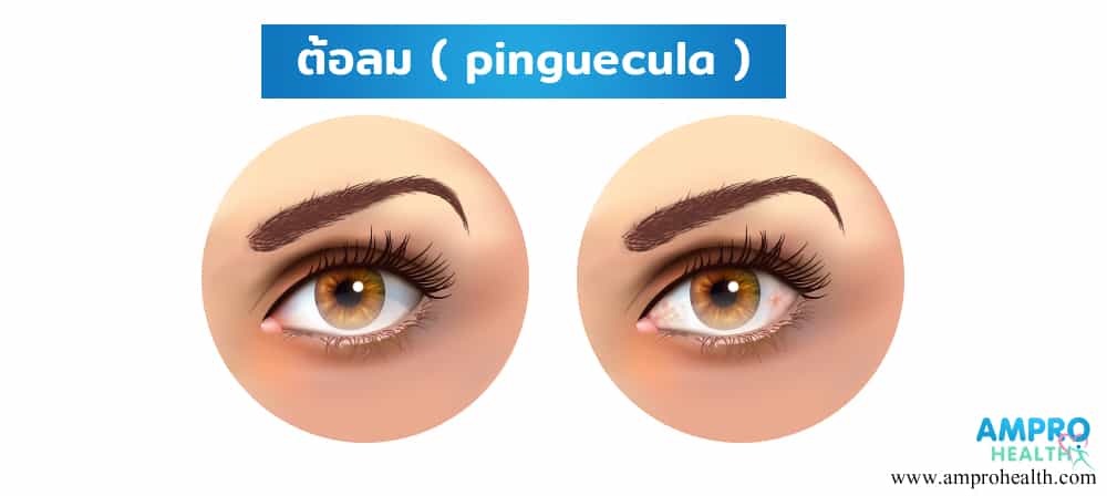 โรคต้อลม ( Pinguecula )