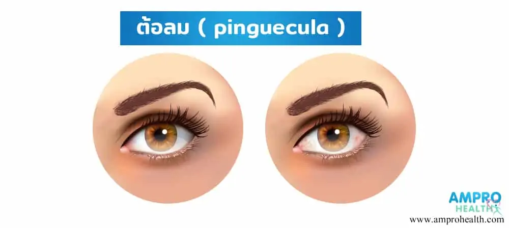 โรคต้อลม ( Pinguecula )
