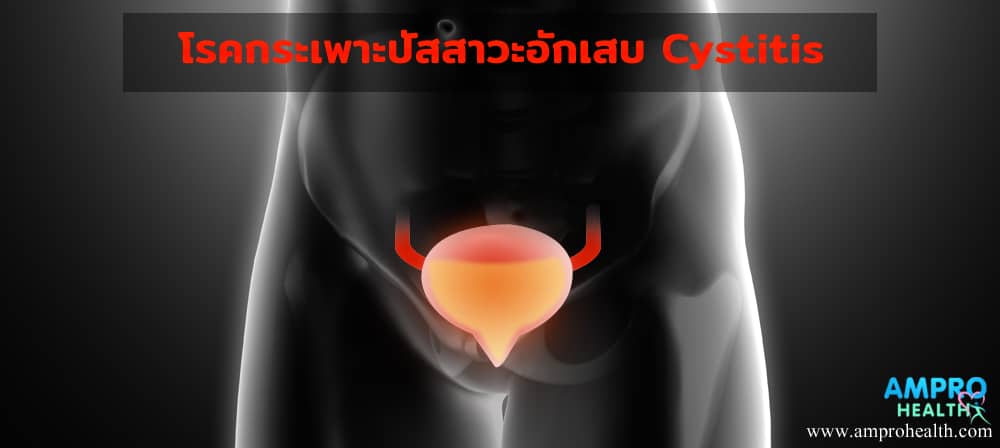 โรคกระเพาะปัสสาวะอักเสบ ( Cystitis )