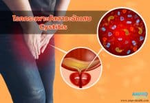 โรคกระเพาะปัสสาวะอักเสบ ( Cystitis ) โรคกระเพาะปัสสาวะอักเสบ ( Cystitis )