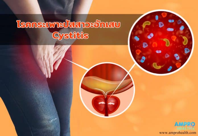 โรคกระเพาะปัสสาวะอักเสบ ( Cystitis )