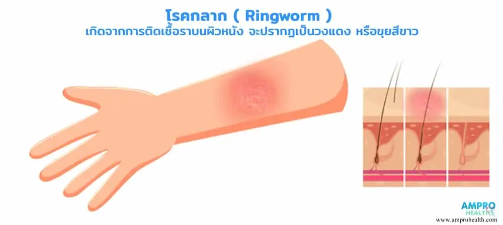 โรคกลาก ( Ringworm )