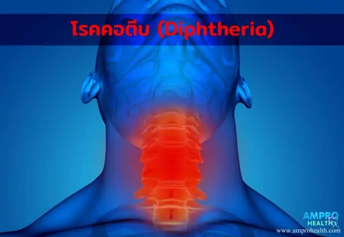 โรคคอตีบ ( Diphtheria )