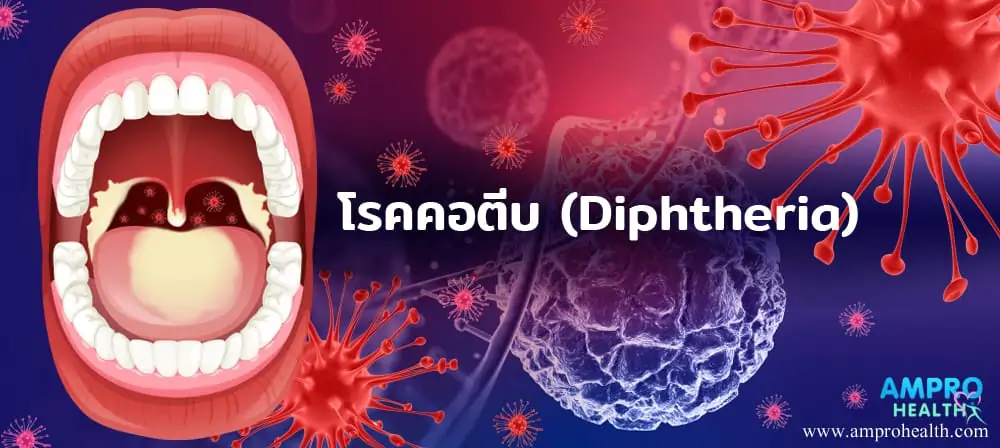 โรคคอตีบ ( Diphtheria )