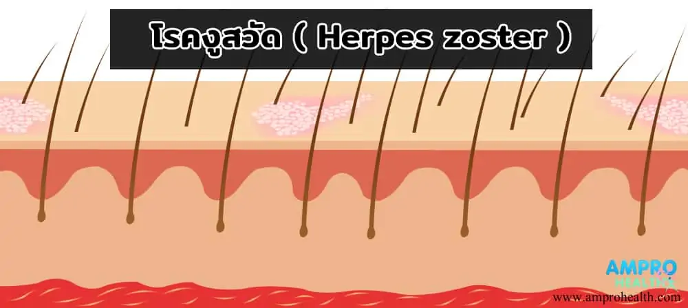 โรคงูสวัด ( Herpes Zoster )