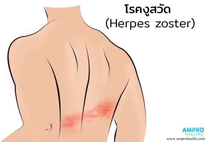 โรคงูสวัด ( Herpes Zoster )