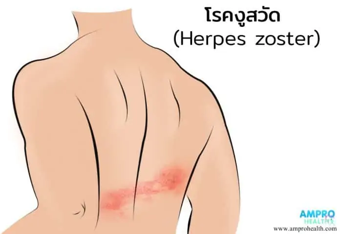 โรคงูสวัด ( Herpes Zoster )