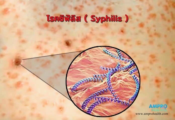 โรคซิฟิลิส ( Syphilis )