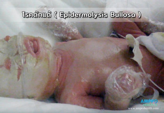 โรคดักแด้ ( Epidermolysis Bullosa )