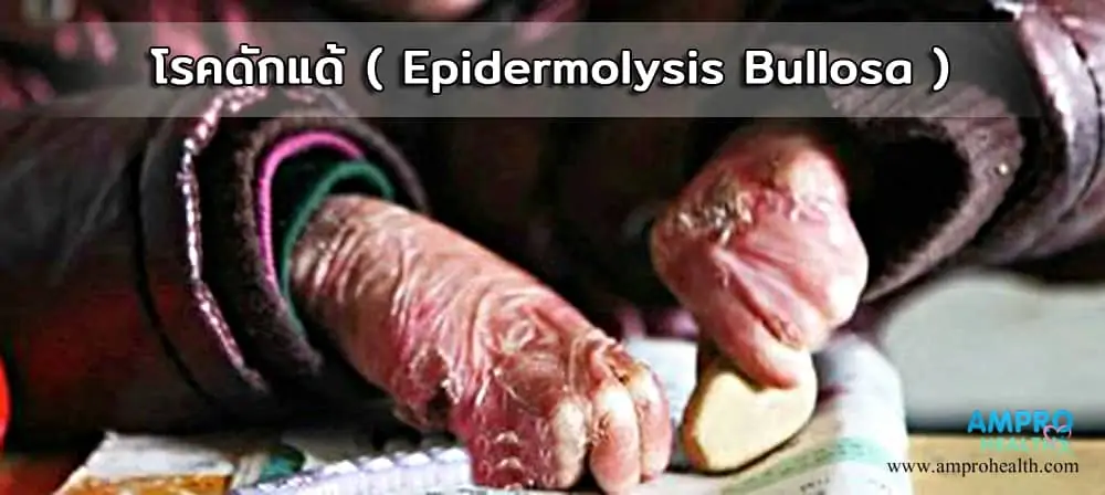 โรคดักแด้ ( Epidermolysis Bullosa )