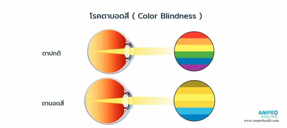 ตาบอดสี เกิดจากสาเหตุอะไร รวมวิธีทดสอบตาบอดสี