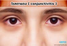 โรคตาแดง ( Conjunctivitis ) โรคตาแดง ( conjunctivitis )
