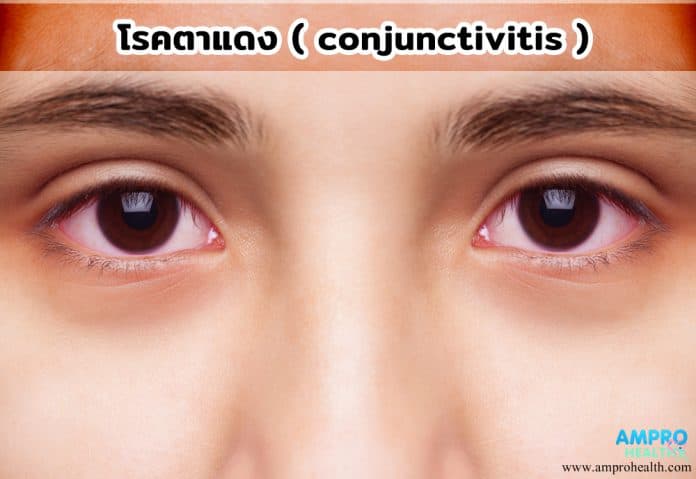 โรคตาแดง ( conjunctivitis )