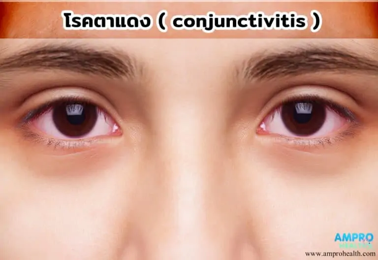 โรคตาแดง ( conjunctivitis )