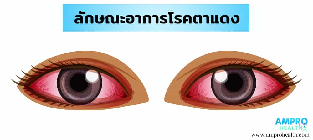 โรคตาแดง ( conjunctivitis )