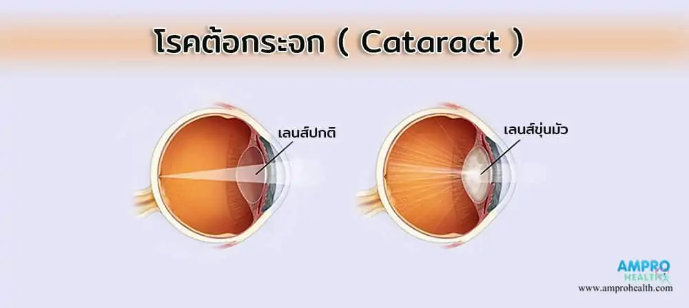 โรคต้อกระจก ( Cataract )