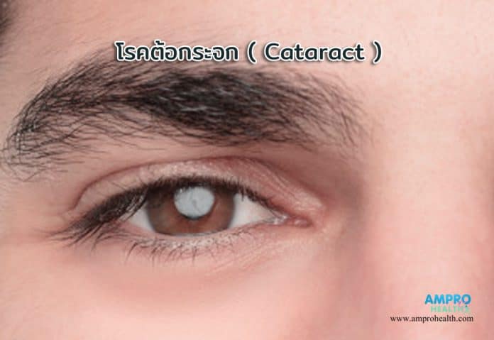 โรคต้อกระจก ( Cataract ) คือ เลนส์ธรรมชาติของดวงตาที่กลายเป็นเมฆมีลักษณะขุ่นมัวรบกวนการมองเห็นของผู้ป่วย พบมากในผู้สูงอายุ 50 ปีขึ้นไปทั้งเพศชายและเพศหญิง