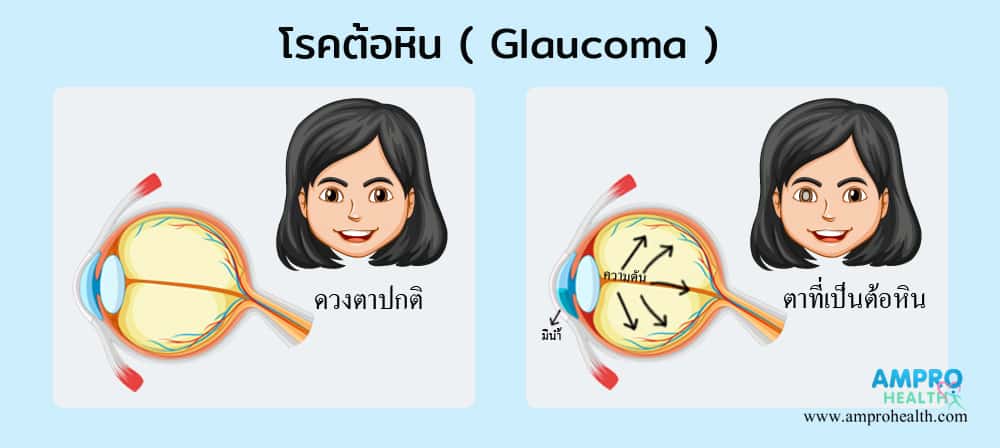 โรคต้อหิน ( Glaucoma ) เป็นอย่างไร