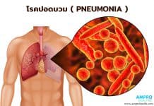 โรคปอดบวม ( Pneumonia ) โรคปอดบวม ( Pneumonia )