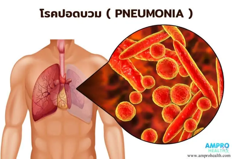 โรคปอดบวม ( Pneumonia )