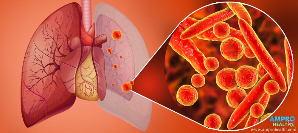 โรคปอดบวม ( Pneumonia )