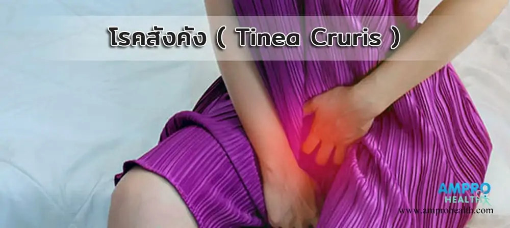 โรคสังคัง ( Tinea Cruris )