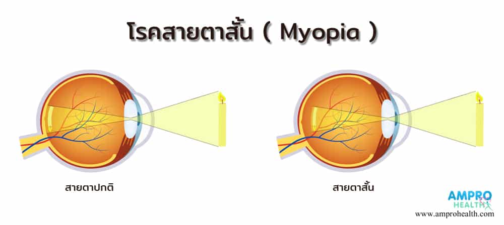 โรคสายตาสั้น ( Myopia )