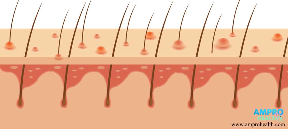 โรคอีสุกอีใส ( Chickenpox / Varicella )