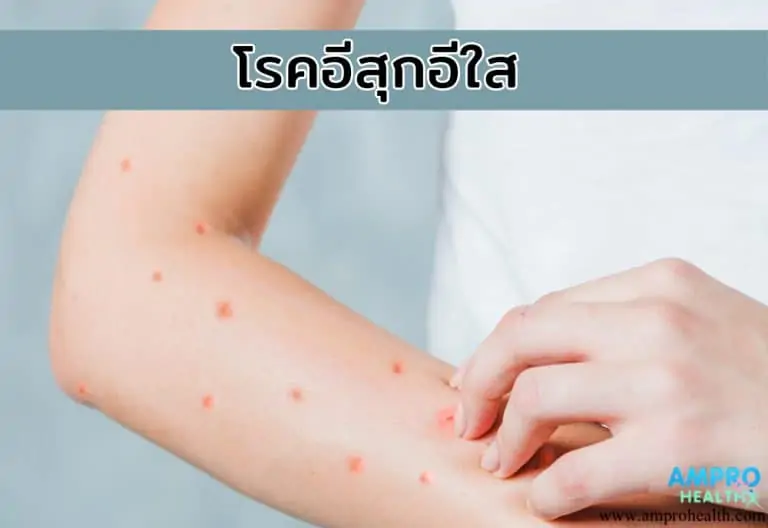 โรคอีสุกอีใส ( Chickenpox / Varicella )