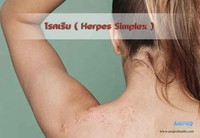 โรคเริม ( Herpes Simplex )