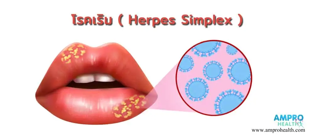 โรคเริม ( Herpes Simplex )