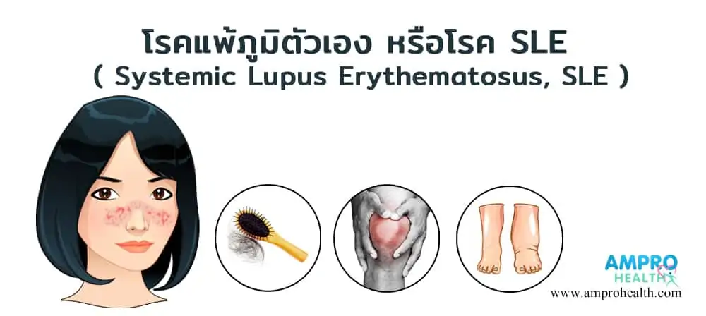 โรคแพ้ภูมิตัวเอง หรือโรค SLE ( Systemic Lupus Erythematosus, SLE )