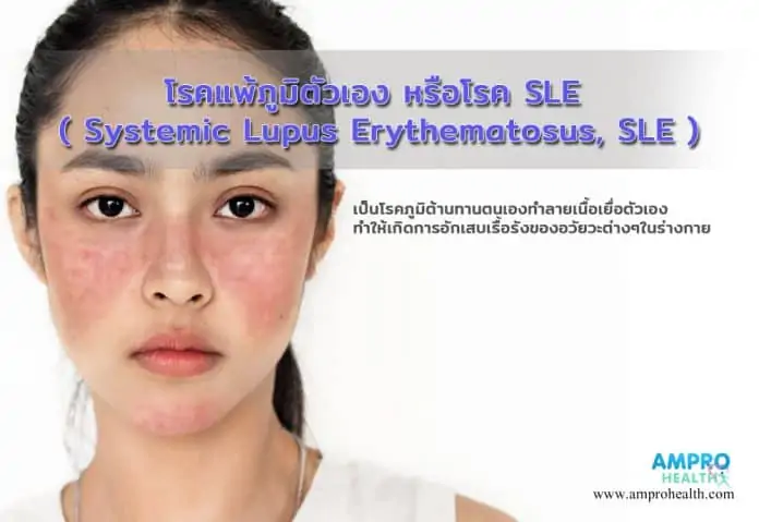 โรคแพ้ภูมิตัวเอง หรือโรค SLE ( Systemic Lupus Erythematosus, SLE )