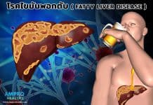 โรคไขมันพอกตับ ( Fatty Liver Disease ) โรคไขมันพอกตับ ( Fatty liver disease )